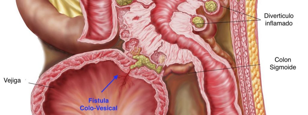 La Fístula Colo-Vesical es una enfermedad en la que existe un agujero anormal que comunica alguna parte del colon con la vejiga urinaria, por lo que la materia fecal o los gases pasan a la vejiga y salen al momento de orinar, ocasionando una infección permanente.