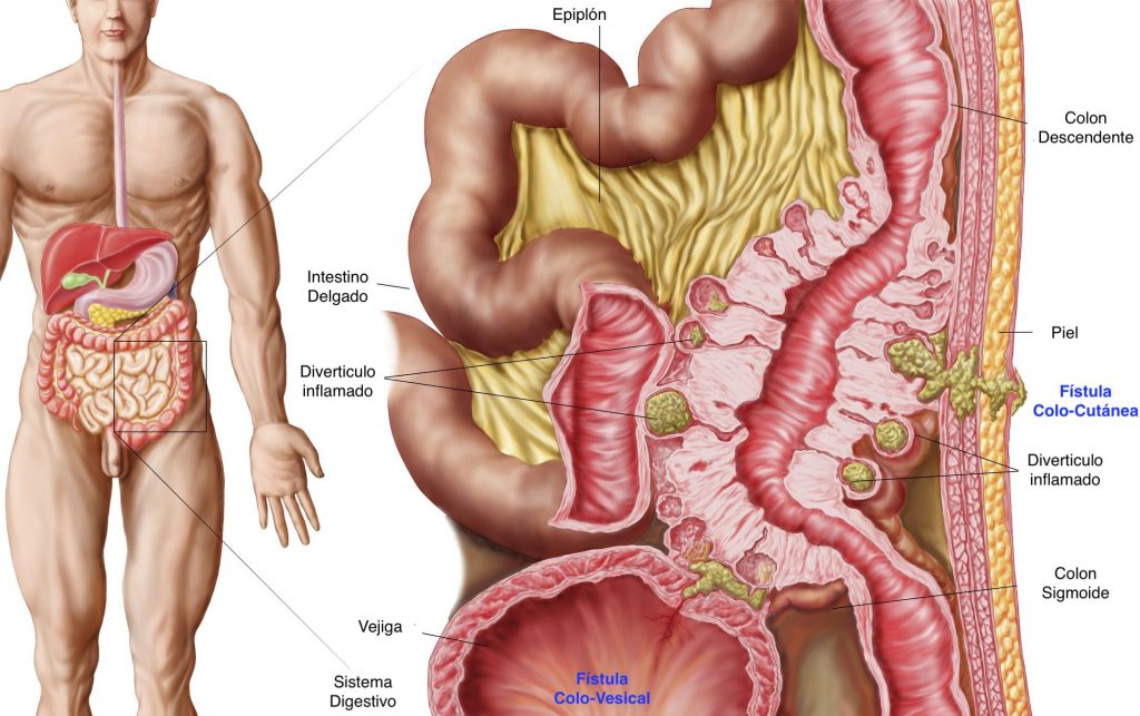 La Fístula Colo-Cutánea es una complicación de los Divertículos de Colon en la que el intestino grueso está comunicado hacia la piel, por lo que la materia fecal sale a través de la piel.
