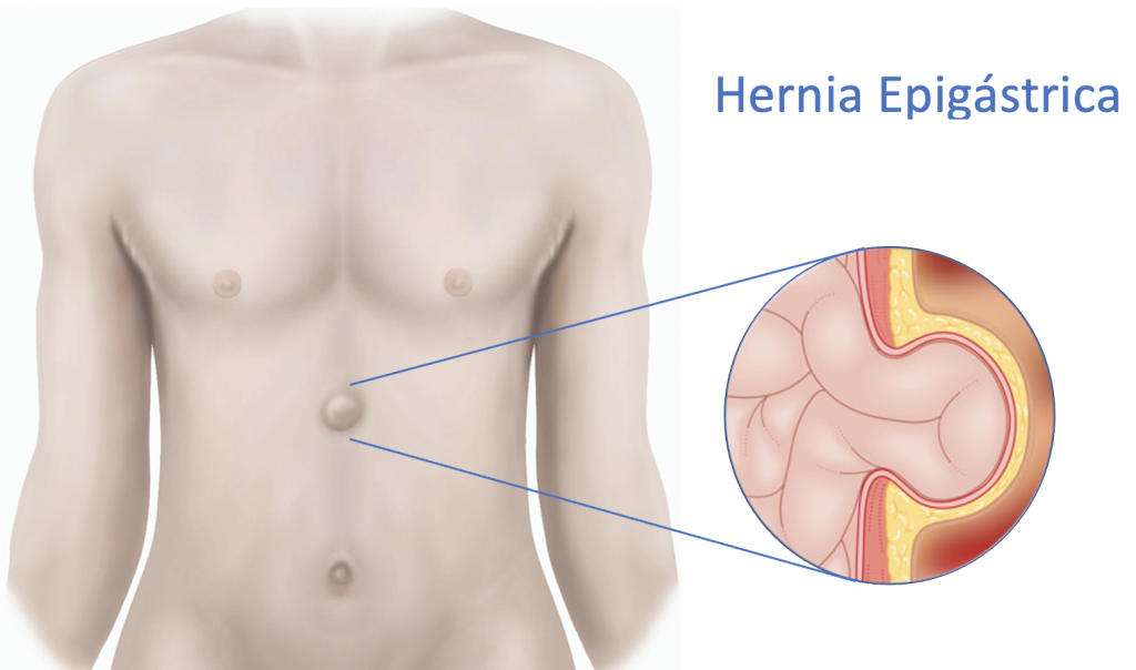 La Hernia Epigástrica es una enfermedad que se caracteriza por un abultamiento en la parte alta del abdomen, dolorosa, y que va creciendo con el tiempo.