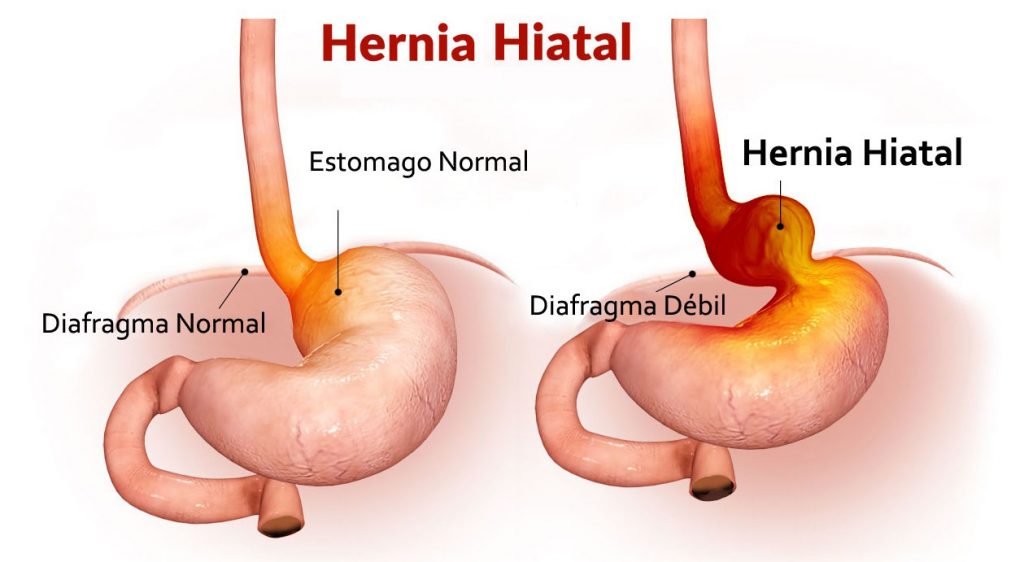 La Hernia Hiatal se refiere a que una parte del estómago 