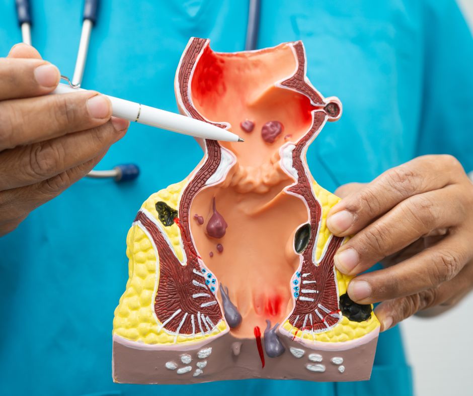 Sangrado rectal: no siempre son hemorroides (causas, señales de alerta y cuándo consultar).