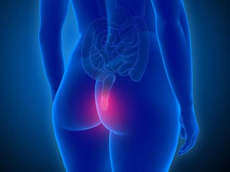 Hemorroides: cuándo consultar y opciones actuales | Coloclinic CDMX